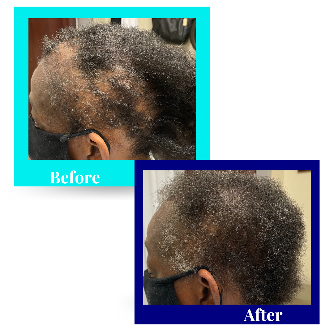 female with scarring alopecia