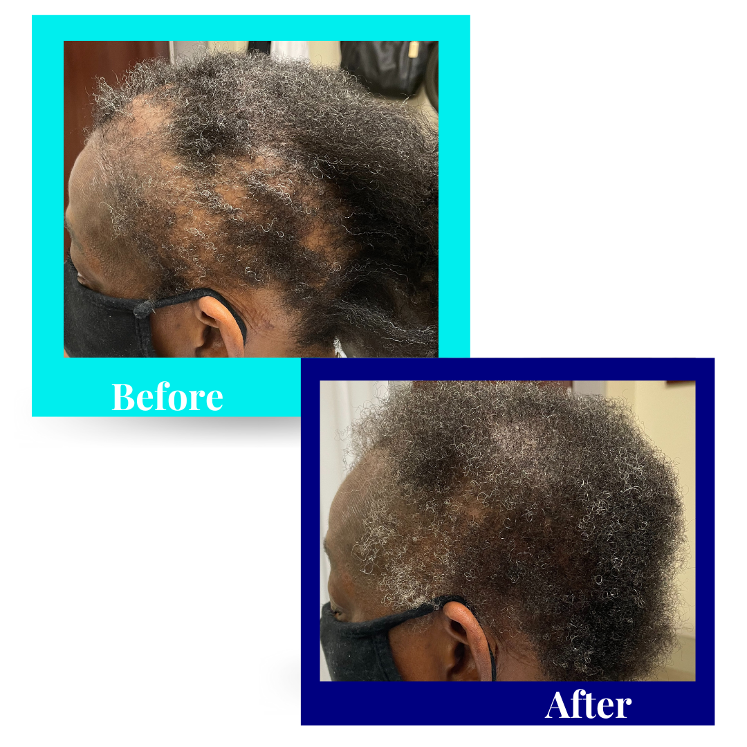 scarring alopecia