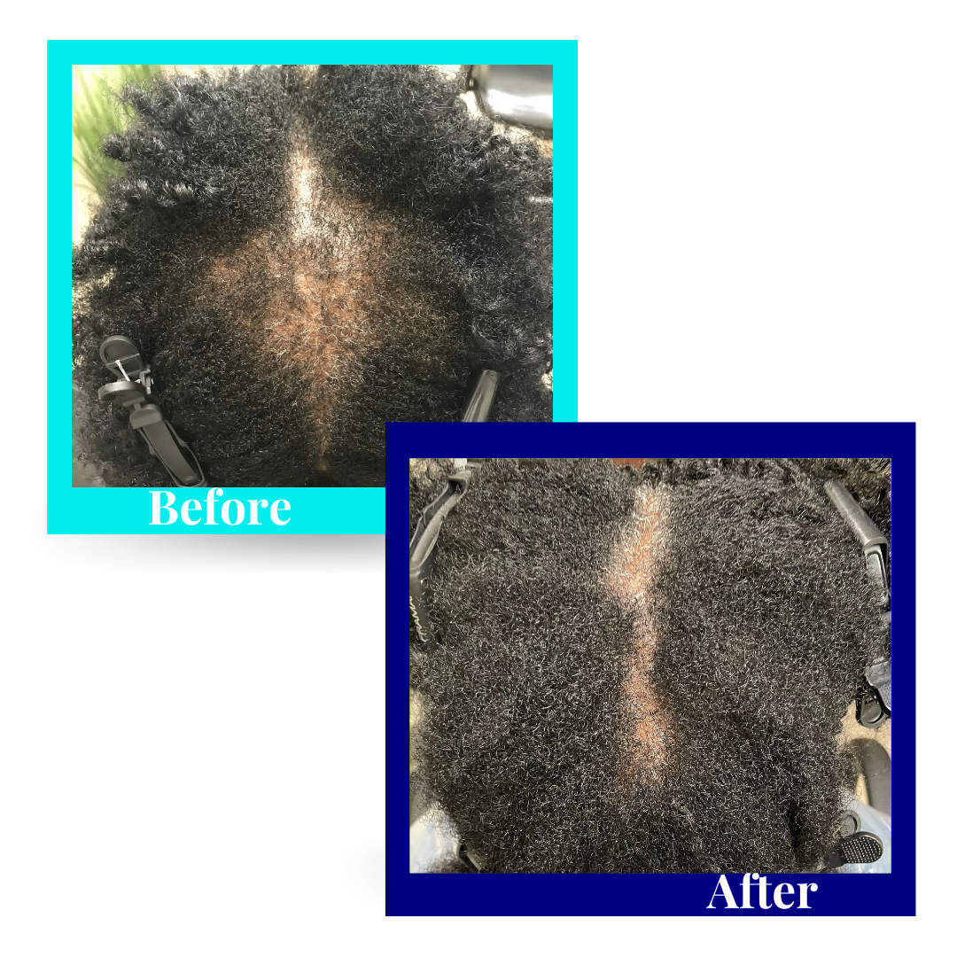 female with crown hair loss